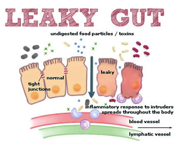 Leaky Gut Treatment in India