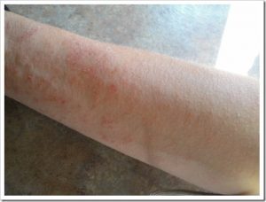 If you want to find out if you have overgrowth? Consider seeing a Functional medicne doctor, who is trained in detecting and treating it.