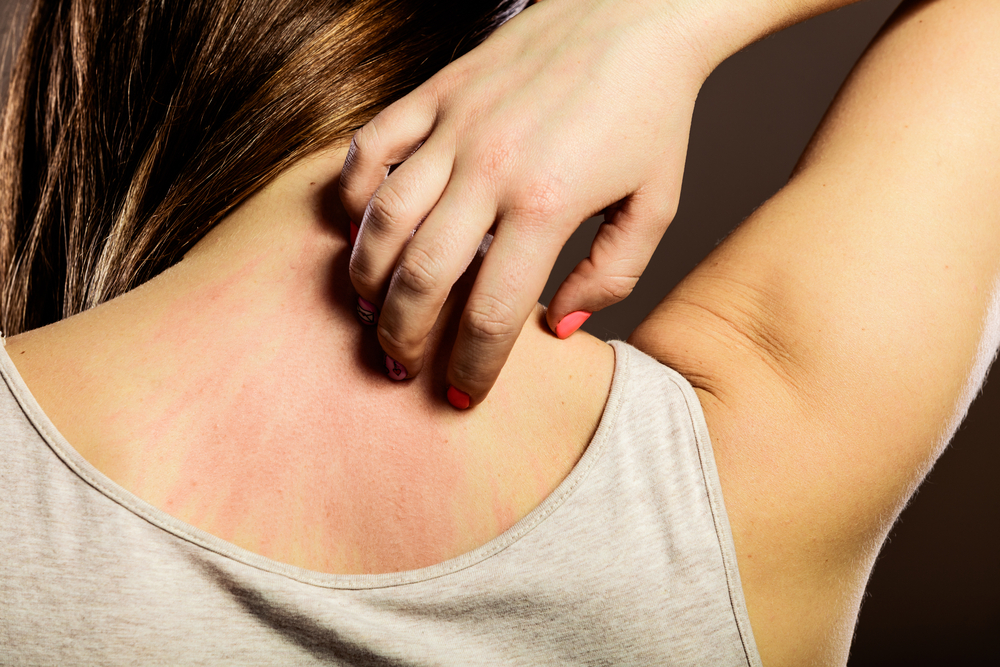 Stress rash, yes stress can cause hives!