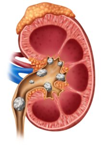 Kidney Stones managed by Functional Medicine - Freedom Age