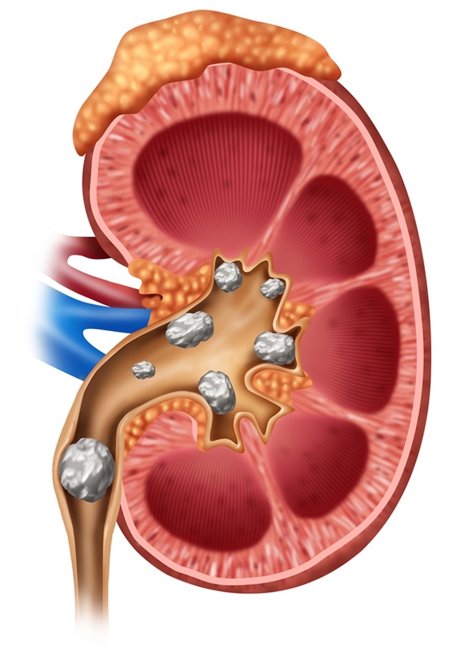 Kidney Stones managed by Functional Medicine