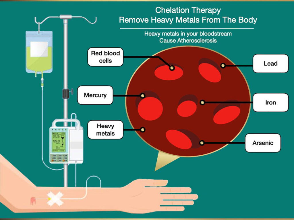 INTRAVENOUS CHELATION THERAPY IN INDIA